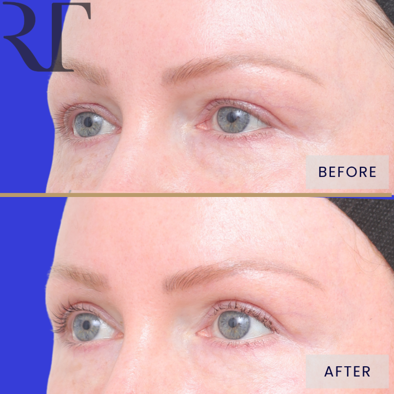 Upper blepharoplasty before and 12 months after, three-quarter view (left side)