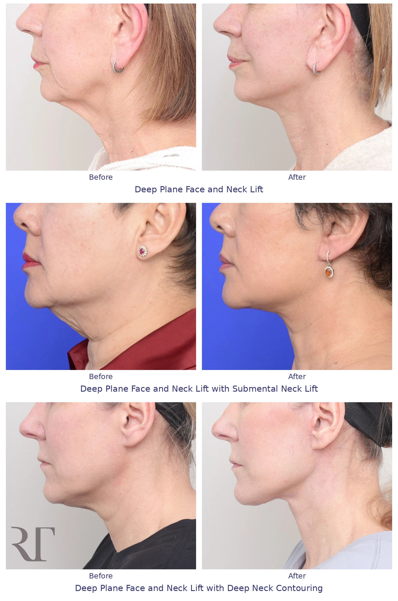 Before and after side profiles of three neck lift patients: deep plane face and neck lift, with submental neck lift, and with deep neck contouring