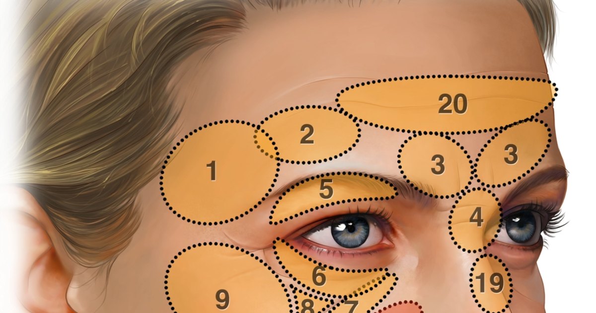 Illustration of the face showing 20 numbered regions where fat grafting may be placed