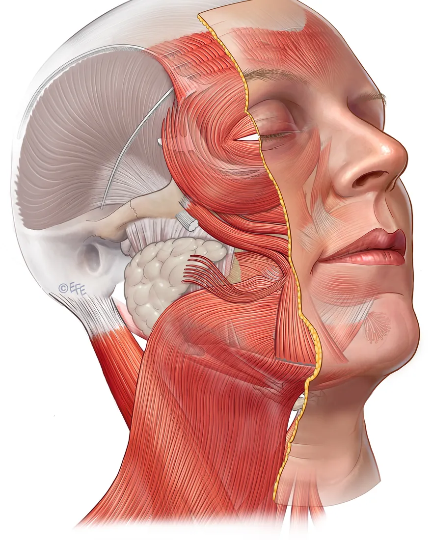 Illustration of the neck and lower face with the skin partly removed, showing the platysma muscle extending from the neck over the jawline, with the submandibular gland beneath it