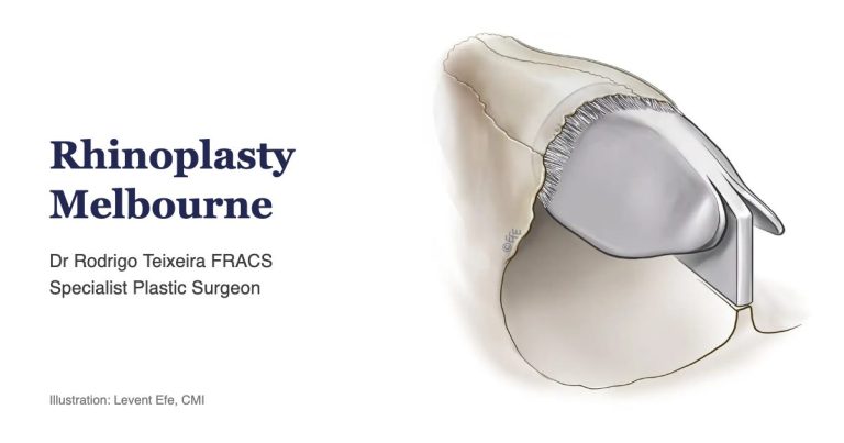 Rhinoplasty Melbourne – Dr Rodrigo Teixeira FRACS, Specialist Plastic Surgeon
