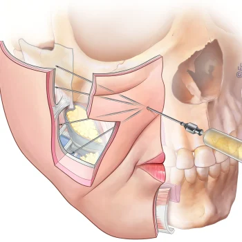Fat graft placement on the cheek