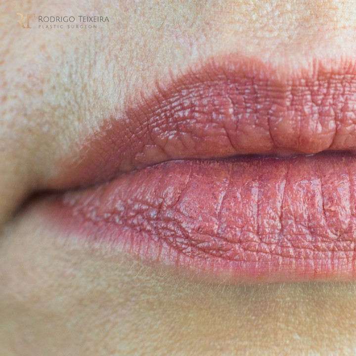 Lip Lifts