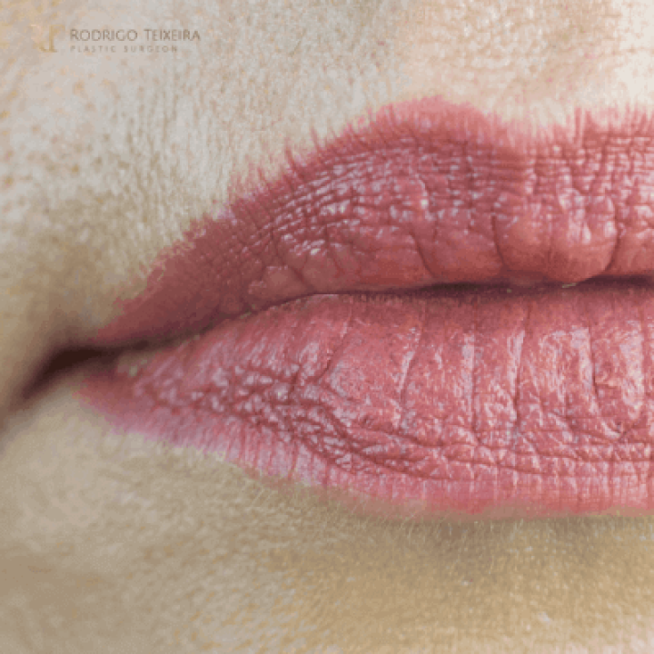Lip-Lifts