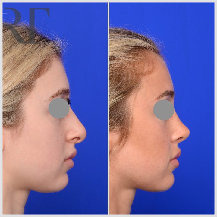 Rhinoplasty before and after, Melbourne Dr Rodrigo Teixeira