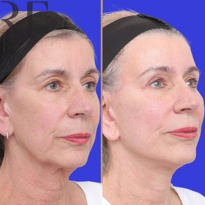 Melopasty - Deep Plane Facelift before and after photos