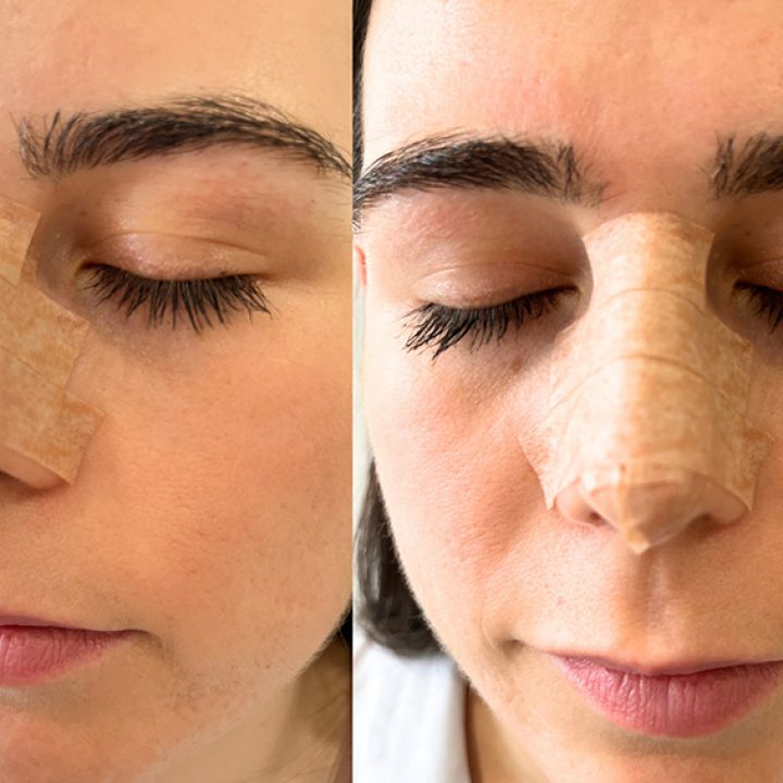 Rodrigo Teixeira - Rhinoplasty Recovery - Swelling & Results Explained