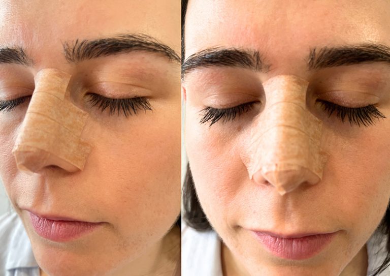 Rhinoplasty recovery: swelling and results explained