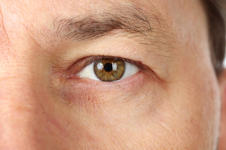Close-up of a man's eye showing upper eyelid skin hooding