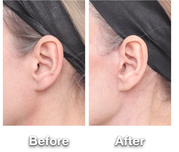 Facelift ear scars before and after – 3 months Facelift before and after showing the scars at 3 months after surgery