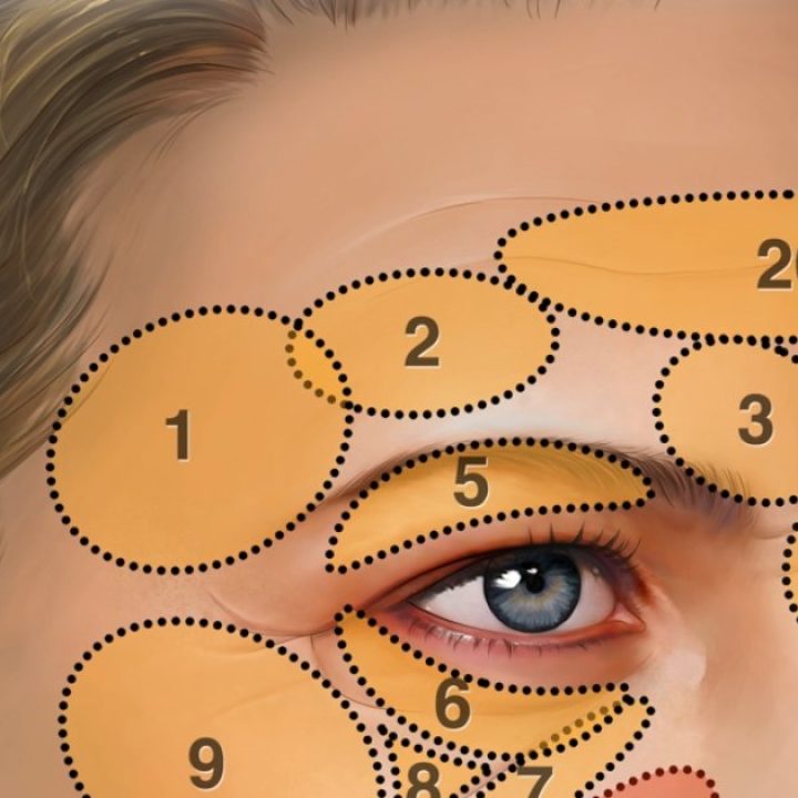 Illustration of the face showing 20 numbered regions where fat grafting may be placed