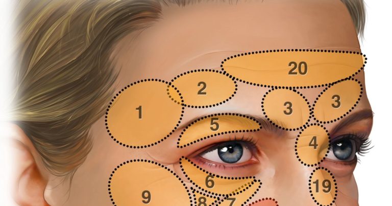 Illustration of the face showing 20 numbered regions where fat grafting may be placed