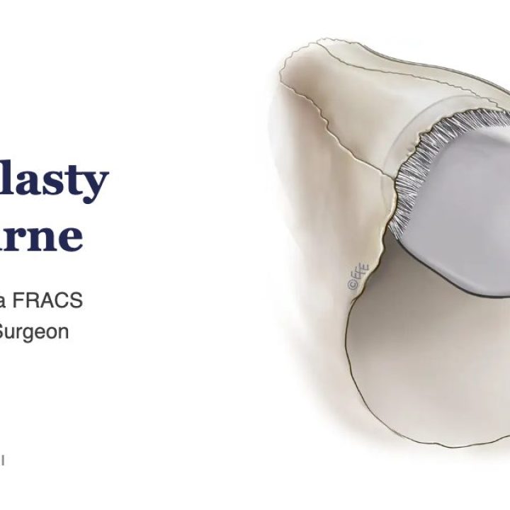 Rhinoplasty Melbourne – Dr Rodrigo Teixeira FRACS, Specialist Plastic Surgeon