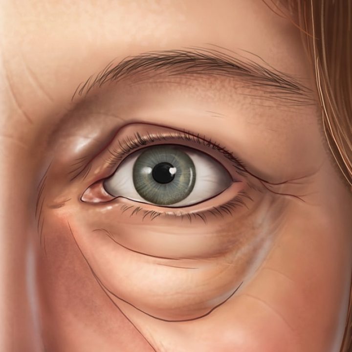 upper and lower eyelid skin excess, muscle laxity and fat pad prominence